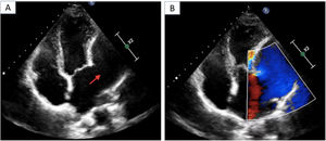 4-Chamber apical view showing (A) left atrial appendage aneurysm (red arrow) with Doppler flow within it (B).