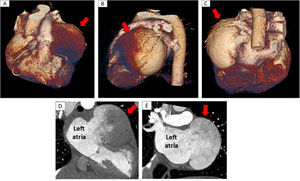 Computed tomography showing the anatomic reconstruction of the left atrial appendage aneurysm (red arrow) from the following perspectives. (A) Anterior, (B) lateral, (C) posterior, (D) slow contrast flow within the aneurysm and (E) absence of thrombi inside it.