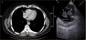 Panel A: A thoracic CT scan revealing an intracardiac mass in the right atrium (white arrow). Panel B: Transesophageal echocardiography confirming the presence of two mobile masses suggestive of thrombus in the right atrium (yellow arrow the larger mass, white arrow the smaller one).