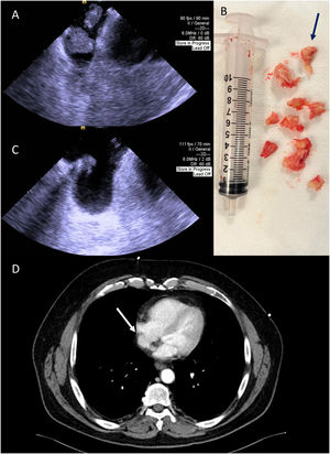 Panel A: Intracardiac echocardiography used to guide mechanical aspiration showing the two masses. Panel B: The fragmented thrombus that was aspirated from the right atrium – predominantly white, compatible with the presence of fibrin (blue arrow). Panel C: Post-procedural intracardiac echocardiography image demonstrating a residual thrombus. Panel D: Thoracic CT angiography performed after the procedure showing small residual thrombus in the right atrium (white arrow).