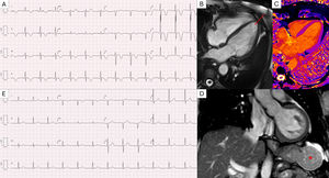 (A) ECG showing high-voltage R waves and global symmetrical T-wave inversion. (B) Cardiac MRI cine b-SSFP four-chambers image showing non-thickened biventricular walls (e.g. interventricular septum of 7 mm) and no signs of apical hypertrophy (red arrow). Tissue characterization sequences including STIR T2-weighted imaging, native T1 mapping (C), and LGE were unremarkable, showing no evidence of myocardial edema, fibrosis, or infiltration. (D) Cardiac MRI coronal TRUFI image showing a round and relatively homogeneous solid lesion in the greater gastric curvature (red asterisk). (E) ECG at one-year follow-up demonstrating complete resolution of the previously observed R and T wave abnormalities.