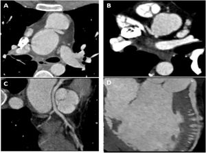 Case examples of patients with abnormal coronary findings on computed tomographic coronary angiography. (A) Interarterial course of the left main coronary artery with acute angulation at the ostium. (B) Variant coronary anatomy pattern with both the left main coronary artery and right coronary artery originating from a rightward SOV. (C) Multiplanar reconstruction showing retroaortic course of the left anterior descending artery in a patient with a single coronary artery originating from a rightward sinus of Valsalva. (D) Multiplanar reconstruction of the left anterior descending artery showing intracavitary course into the right ventricle.