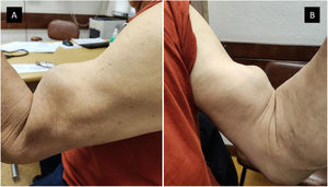 Popeye sign. Patient with wild-type transthyretin amyloidosis and chronic rupture of the biceps tendon in the left arm. (A) Left side view and (B) right side view.