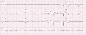 Twelve-lead electrocardiogram in a patient with wild-type transthyretin amyloid cardiomyopathy, showing atrial fibrillation rhythm, low voltage criteria in the peripheral leads, and a pseudo-infarction pattern in the inferior and V1–V3 leads.