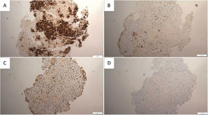 Endomyocardial biopsy in a patient with transthyretin amyloid cardiomyopathy (ATTR-CM). Immunoperoxidase technique was used on paraffin sections. Transthyretin deposition was detected in the myocardium (A), while screening for lambda light chains (B), kappa light chains (C) and serum amyloid A (D) proved to be negative, thus confirming the diagnosis of ATTR-CM. Image courtesy of Helena Sousa, MD, Nephrology Department, Unidade Local de Saúde de S. José, Lisboa, Portugal.