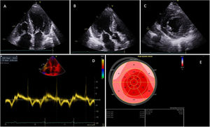 Transthoracic echocardiogram in a patient with transthyretin amyloid cardiomyopathy. (A–C) Left ventricular (LV) hypertrophy with a sparkling pattern of the myocardium on the two-dimensional transthoracic echocardiogram in 4-chamber (Video 1) (A), 3-chamber (Video 2) (B) and parasternal short-axis (Video 3) (C) views; (D) mitral annular tissue Doppler imaging, showing LV diastolic dysfunction with reduced septal e′ velocity (5 cm/s) and increased E/e′ ratio (20.9); (E) LV bullseye plot with peak systolic global longitudinal strain, showing an apical sparing pattern.