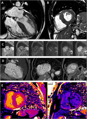 Cardiac magnetic resonance (1.5 T) in a patient with transthyretin amyloid cardiomyopathy. (A) Cine image in horizontal long-axis view (Video 4) and (B) cine image at the basal slice of short-axis view of the left ventricle (balanced steady-state free precession sequences), showing left ventricular hypertrophy with a maximum left ventricular wall thickness of 19 mm at the mid inferoseptal wall and mild pericardial effusion; (C) Look-Locker sequence, revealing abnormal gadolinium kinetics with myocardial signal nulling occurring before blood pool signal nulling; (D) diffuse transmural late gadolinium enhancement, observed in 4-chamber view and basal and mid left ventricular (LV) short-axis slices (phase sensitive inversion recovery sequence); (E) native T1 mapping (left) and post-contrast T1 mapping (right), performed using a modified Look-Locker inversion recovery sequence at the basal LV short-axis slice, showing high native T1 (1179 ms) and expanded extracellular volume (44%); the resulting pixel-by-pixel T1 color maps regarding native T1 are displayed using a customized lookup table, in which normal myocardium is in blue-purple and increasing T1 is represented in more orange and yellowish colors.
