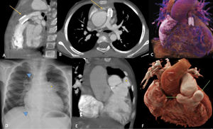 Pre- and post-operative images of a case of Tetralogy of Fallot underwent RVOT stenting followed by intracardiac repair. Preoperative cardiac CT (A–C) showing RVOT stent in situ (arrows in A and B) with good flow in main and branch pulmonary arteries. Chest radiograph (D) two years after intracardiac repair showing prominent mediastinal bulge in the location of RVOT (asterisk) with vascular plugs in the aortopulmonary collaterals (arrowheads). Coronal reconstructed image (E) of cardiac CT showing pseudoaneurysms of the RVOT patch (asterisk). The reconstructed CT cinematic rendering images better depict the two mirror-image proximal suture line aneurysms (arrows in F). CT: computed tomography; RVOT: right ventricular outflow tract.