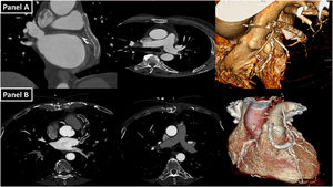 Panel A: Coronal and axial computed tomography (CT) image and three-dimensional (3D) reconstruction showing complete thrombosis of the circumflex artery, fully contained within the VEST device. Panel B: Axial CT image and 3D reconstruction showing severe stenosis at the origin of a radial artery graft to the second obtuse marginal branch and at the origin of an SVG to the right coronary artery. Additionally, there is a marked thinning and a significant reduction in the graft