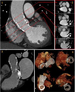 Post-procedural cardiac CT to access prosthesis morphology: modified coronal plane (1), short-axis (2), long-axis 3-chamber view (3) and volume rendering depicting the relation of TAVI prosthesis with the MMV with the restriction in expansion (elliptical shape) in the distal struts (4). This deformation is below the plane of the valve (CoraValve has a supraannular design).