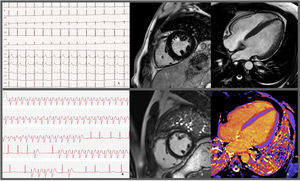 Electrocardiograms and cardiac magnetic resonance imaging exams performed on the patient. 1: EKG performed prior to hospitalization discharge showing no remarkable findings other than an rSr’ pattern in lead DIII. 2 and 3: MRI prior to hospitalization discharge revealing slight concentric hypertrophy, without enhancement. 4: Recording of a wide QRS tachycardia, raising the hypothesis/possibility of a non-sustained ventricular tachycardia. 5 and 6: MRI during follow-up, showing absence of LGE and normal native T1 mapping values (considering the reference values for the sequence and local MRI laboratory).