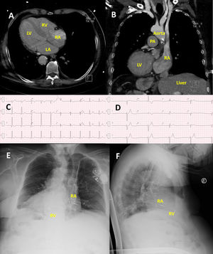 Dual-chamber pacemaker implantation in a patient with situs inversus totalis with dextrocardia. (A) Axial view and (B) coronal view of thoracic computed tomography scan showing mirror-image anatomy with dextrocardia, normal atrioventricular and ventriculoarterial connections, and right-sided liver. (C) Baseline ECG showing sinus rhythm with right bundle branch block and left posterior fascicular block. (D) ECG performed after syncope revealing trifascicular block with second-degree atrioventricular block Mobitz type II. (E) Posteroanterior and (F) lateral chest radiographs demonstrating left-sided pacemaker generator with transvenous leads directed toward the right atrial appendage and right ventricular apex, confirming successful pacemaker implantation. LA: left atrium; LV: left ventricle; RA: right atrium; RV: right ventricle; PA: pulmonary artery.