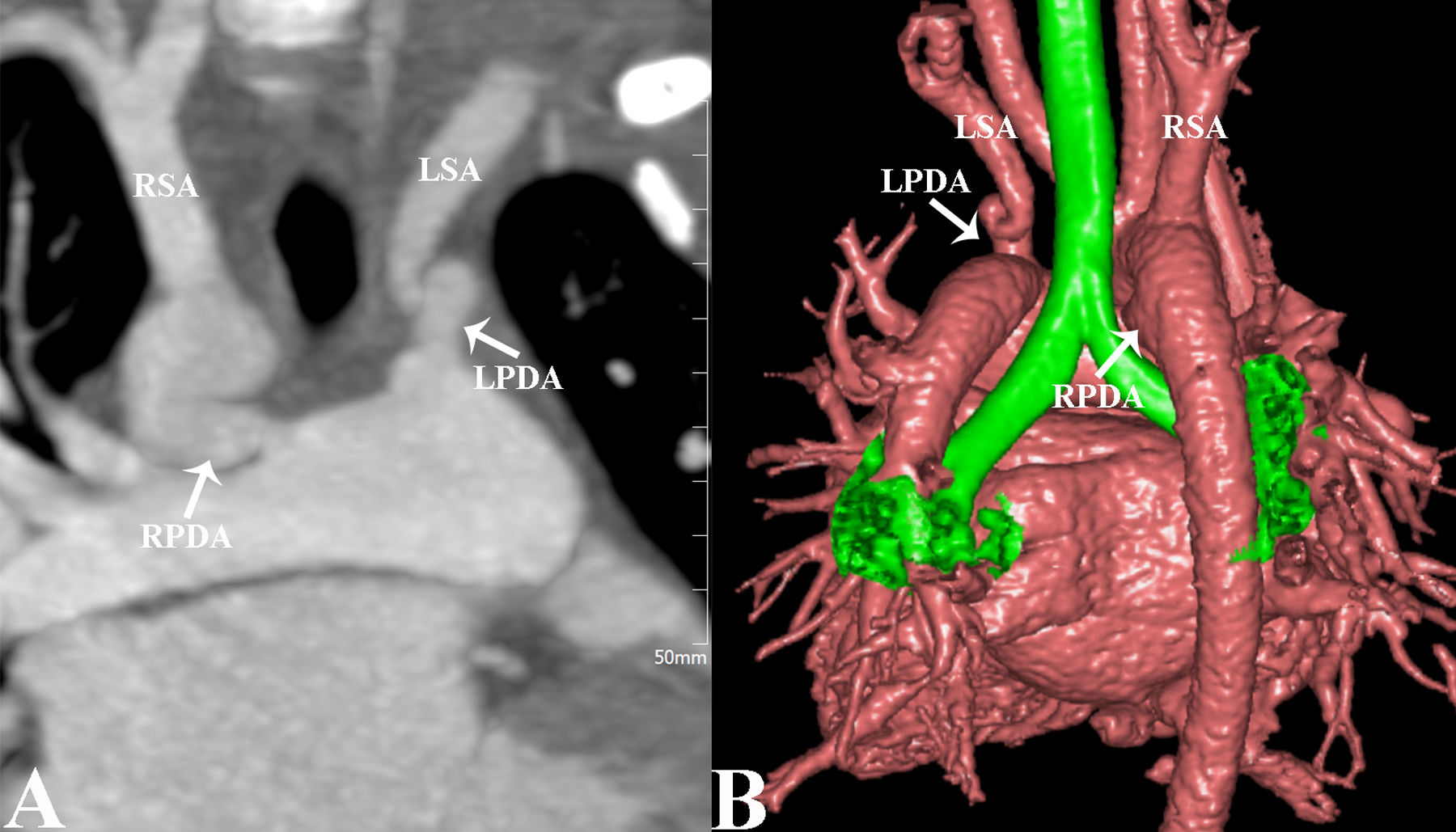 Bilateral patent ductus arteriosus anomaly | Revista Portuguesa de ...