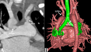 Bilateral patent ductus arteriosus anomaly | Revista Portuguesa de ...