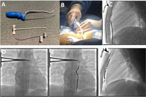 Positioning of the dedicated substernal lead during one of the implant procedures. (A) Dedicated sternal tunneling tool; (B) positioning of the tunneling tool in the incision site; (C) the tunneling rod was advanced under fluoroscopic guidance; (D) the lead delivery sheath was positioned in the anterior mediastinum along the posterior sternum; (E) the lead was then tunneled and positioned to maximize R-wave sensing and shock vector efficacy; (F) the final lead position was in close proximity with the posterior sternum.