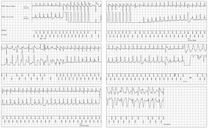 EGM of EV-ICD shock. The EGM analysis showed a regular narrow tachycardia, cycle 280 ms (214 bpm), labeled as fast ventricular tachycardia (FVT). The device delivered ATP but the tachycardia persisted within the same cycle length (270–290 ms). A second burst was delivered, followed by a shock of 31 J.