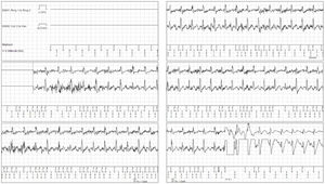 EGM of EV-ICD shock. The EGM analysis showed many irregular ventricular signals of low amplitude lasting for more than 30 seconds, interrupted by the shock of the device.