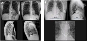 Chest X-ray imaging at follow-up. (A) Anteroposterior and left lateral thoracic radiographs obtained at discharge (images on the left) and at three-month follow-up, confirming unchanged lead trajectory and generator positioning. (B) This patient had a previous partial sternotomy from a previous surgery to remove a thymoma and was selected for an EV-ICD. The chest X-ray shows a minor tilting of the lead towards the right side that did not affect the final parameters.