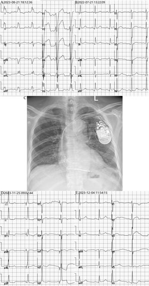 Electrocardiograms before and after left bundle branch area pacing. (A) The electrocardiogram (ECG) showed left bundle branch block after admission on August 19th, 2023. (B) No LBBB on ECG one year before admission. (C) CRT-D pacemaker was performed. (D) QRS duration was 108 ms after LBBAP. (E) The ECG revealed sinus rhythm with a QRS duration of 102 ms without pacing at 100-day follow-up after implantation of a CRT-D pacemaker.