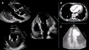 Initial etiological workup of increased left ventricular wall thickness. (A) Transthoracic echocardiogram at admission showed increased wall thickness in the mid and basal segments of the lateral and posterior walls of the left ventricle. (B) Contrast-enhanced chest computed tomography revealed an image suggestive of thrombus adherent to the anterior, lateral, and inferior walls of the left ventricle. (C) Contrast-enhanced transthoracic echocardiogram documented a left ventricular mass with reduced perfusion, suggestive of thrombus.