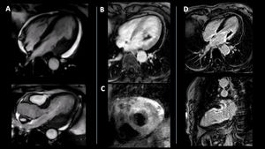Etiological investigation of MINOCA using cardiac magnetic resonance (CMR). (A) CMR in 4-chamber and 3-chamber views showed increased left ventricular wall thickness, more pronounced in the basal segment of the lateral and posterior walls. (B) Adherent mass suggestive of thrombus (29×16 mm) on early late gadolinium enhancement sequence. (C) T2-weighted sequence showing increased signal in the mid segments of the anterior, lateral and posterior walls. (D) Subendocardial late gadolinium enhancement in the mid-basal region of the posterior, lateral, anterior, and inferior walls and irregular not-enhanced mass adherent to the basal lateral wall suggestive of thrombus.