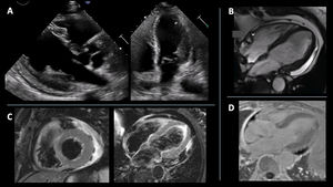 Imaging assessment following initiation of immunosuppressive therapy. (A) Echocardiogram performed 13 days later showing localized wall thickness reduction. (B) Cardiac magnetic resonance (CMR) imaging in four-chamber view, performed 6 months later, showing mild hypertrophy in the basal segment of the lateral wall of the left ventricle. (C) T2-weighted CMR sequence showing no evidence of myocardial oedema. (D) CMR showing subepicardial/mid-wall late gadolinium enhancement with linear distribution in the basal segment of the posterior wall.