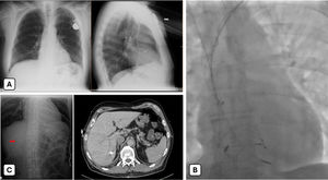 (A) Initial chest X-ray – position of the leads before extraction. (B) Metallic ring detached from the RA lead tip and free into the RA. (C) Postprocedural imaging demonstrating the metallic ring lodged in hepatic segment VII.