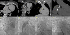 Preprocedural imaging (A and C): communication between the Fontan conduit (*) and a pseudocavity (+) located adjacent to the previously placed ASD closure device (continuous arrow), with an entry point (dashed lines) measuring 1.2 cm in maximum diameter. Intraprocedural angiography and intervention (E–H): after confirming the presence of the connection, balloon sizing was performed using a 25 mm balloon (waist diameter 16 mm) and a 24 mm Amplatzer ASD occluder was deployed. No increase in Fontan pressures was confirmed prior to device release. Follow-up CT (B and D): a well-positioned ASD occluder (discontinuous arrow), juxtaposed to the previous device (continuous arrow), with complete occlusion of the cavity.