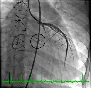 Complete occlusion of the mid-left circumflex.