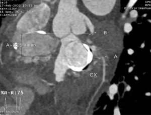 CT coronary angiography: close proximity of the LCx to the mechanical mitral valve.