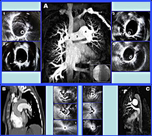 Further illustrates the integration of multimodal imaging in diagnosis and procedural planning, showing sequential IVUS slices correlated to CT and angiographic anatomy. This approach enabled precise thrombus localization and device navigation.