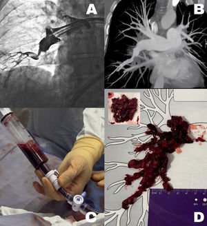 (A) Angiography demonstrating thrombus. (B) Thrombus burden in computed tomography imaging. (C) Imaging showing aspiration device. (D) Schematic representation of aspirated thrombus burden in the right pulmonary artery.
