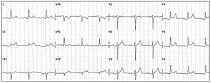 ECG showing diffuse ST-segment elevation.