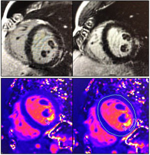 CMR showing LGE in a non-ischemic pattern involving the LV free wall (upper panels) and increased myocardial T2 values (lower panels) consistent with myocardial edema.
