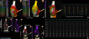 Electroanatomical maps of the right atrium. (A) Local activation map during sinus rhythm and pacing from proximal CS electrodes (left anterior oblique view). (B) Peak frequency and emphasis maps (left anterior oblique view) obtained during sinus rhythm and CS pacing. The peak frequency map displays the distribution of high-frequency electrogram components, where higher values (white areas) indicate sharper, near-field local activations. The emphasis map quantifies the stability and organization of the local signals, with higher values (purple areas) representing more regular and well-defined electrograms. The frequency cutoff value was set to 300 Hz. The area of higher peak frequency was more focused on the right anteroseptal region. (C) Atrioventricular electrogram separation showing disappearance of pre-excitation during cryoenergy application. (D) Electrocardiogram at the end of the procedure.