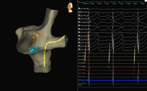 Slow-pathway cryoablation. In panel A, left lateral view of virtual three-dimensional geometry of right atrium showing a catheter in CS (yellow), orange dots in the area of His bundle and cryoablation lesions in slow-pathway region (blue). In panel B, intracavitary signals showing slow-pathway potential in ablation catheter.