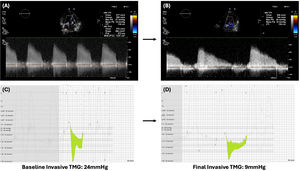 Procedural outcomes – echocardiographic evaluation of TMG before (A) and after (B) lithotripsy-assisted balloon valvuloplasty; invasive measurement of TMG before (C) and after (D) lithotripsy-assisted balloon valvuloplasty. TMG: transmitral gradient.