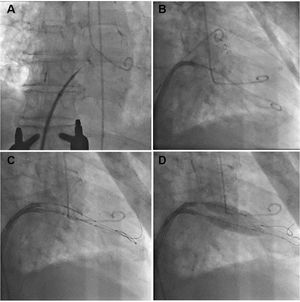 Fluoroscopy images of lithotripsy-assisted balloon valvuloplasty – (A) transseptal puncture; (B) progression of first Agilis™ steerable sheath; (C) delivery of two peripheral lithotripsy 12×30 mm Shockwave® balloons over V18™ guidewires through two Agilis™ steerable sheaths; (D) simultaneous balloon inflation with lithotripsy pulse delivery.