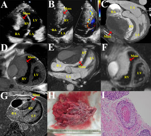 (A) Transthoracic echocardiography reveals a mixed hypoechoic mass measuring 8.1 cm×5.4 cm×5.8 cm compressing the RV. (B) Color Doppler flow imaging shows the blood flow signal within the mass. (C) Contrast-enhanced cardiac CT reveals a giant mass with cystic changes and necrosis, invading the pericardium and compressing the RV with crescent-shaped alteration. (D–G) Cardiac magnetic resonance shows an infiltrative mass with isointense and slightly hyperintense on black-blood imaging (D), intermediate hyperintense on bright-blood imaging (E), significant hyperintensity on T2-weighted short tau inversion recovery imaging (F) and heterogeneous enhancement and necrotic core on delayed gadolinium enhancement (G). (H and I) The gross and histopathological analysis confirm that tumor is a well-differentiated squamous cell carcinoma. LA: left atrium; LV: left ventricle; RA: right atrium; RV: right ventricle.