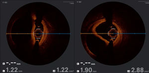 Imaging-guided strategies can help restore blood flow while minimizing the length of stents used in selected high-risk coronary dissections.