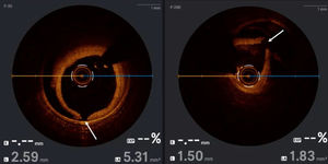 Post-cutting-balloon OCT demonstrating linear intimal fenestrations (arrows) with decompression of the intramural hematoma.