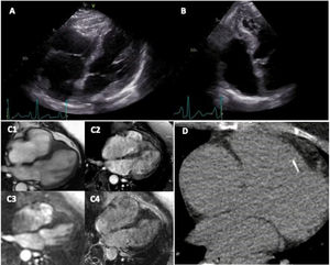 (A and B) TTE, four chamber view showing mildly dilated right ventricle with apical obliteration. (C1) Cardiac MRI, apical right ventricle obliteration. (C2) Cardiac MRI, early gadolinium enhancement, no thrombi. (C3) Cardiac MRI, perfusion, no thrombi. (C4) Cardiac MRI, no late gadolinium enhancement. (D) Cardiac CT calcium score, calcification of the endomyocardial border.