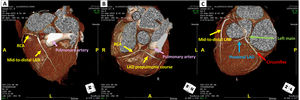 Coronary computed tomography angiography (CCTA). (A–C) An anomalous LAD segment arising from the right coronary artery (RCA) ostium, taking a prepulmonic course to the anterior interventricular groove, consistent with a “long LAD”. No significant coronary stenosis. (A) Mid-to-distal LAD originating from the RCA (arrow). (B) Prepulmonic course of the LAD. (C) Integrated view: mid-to-distal LAD from the RCA (yellow arrow), proximal LAD (blue arrow) from the left main coronary artery (green arrow), and circumflex artery (red artery).