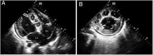 (A) Two-dimensional (2D) transthoracic echocardiography showing multiple hydatid cysts in the interventricular septum in 4-chamber view; (B) 2D transthoracic echocardiography showing multiple hydatid cysts in the interventricular septum in left ventricular short-axis view.