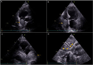 Transthoracic echocardiography revealing a large mass (yellow arrows) occupying almost the entire right atrium (A–C), without obstruction of the tricuspid valve, and extending into the inferior vena cava (D).