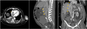 Computed tomography showing a large heterogeneous mass in the inferior vena cava, extending into the right atrium (yellow arrows).