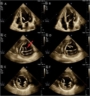 (A and B) Apical four-chamber views of transthoracic echocardiography showing snapshots of a strand-like hypermobile structure within left ventricular (LV) cavity attached to the mid portion of the interventricular septum consistent with a ruptured fibromucular false tendon. (C and D) Parasternal short axis views of the same patient showing false duplication of the false tendon image due to refraction artifact (red arrow). (E and F) Omitting of the ghost artifact by small tilting of the probe so a little change in direction of ultrasound beam propagation.