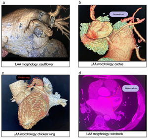 Different LAA types as shown by cardiac CT: (a) cauliflower, (b) cactus, (c) chicken wing, and (d) windsock.