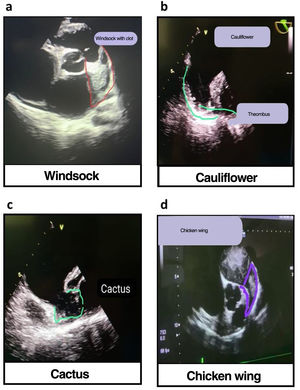 Thrombus in different locations in the left atrial appendage: (a) windsocks, (b) cauliflower, (c) cactus, and (d) chicken wing.
