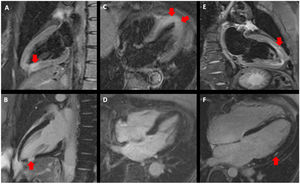 Examples of CMR findings in each subgroup: MINOCA: (A) T2 STIR 2 chamber view showing sub-endocardial edema (arrow) and (B) 2 chamber view showing transmural late gadolinium enhancement (LGE) in the inferior wall (arrow); Takotsubo (C and D): T2 STIR showing apical edema in 4 chamber view (arrows) without LGE; myocarditis (E and F): T2 stir 2 chamber view showing small intramyocardial LGE in the anterior wall (arrow) and 4 chamber view showing intramyocardial edema in the anterolateral wall (arrow).